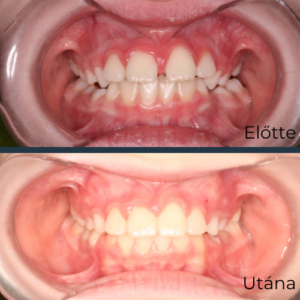 Felnőtt fogszabályozás, fogszabályozás, fogszabályozó, HermannOrtho, hermann Gábor, Hermann Dental and Medical