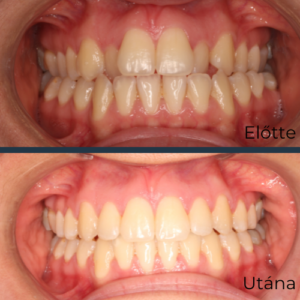 Felnőtt fogszabályozás, fogszabályozás, fogszabályozó, HermannOrtho, hermann Gábor, Hermann Dental and Medical