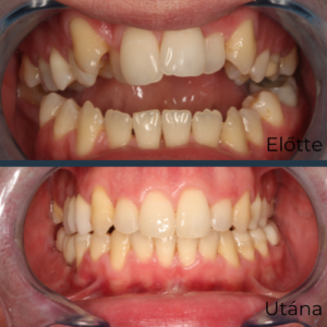 Felnőtt fogszabályozás, fogszabályozás, fogszabályozó, HermannOrtho, hermann Gábor, Hermann Dental and Medical